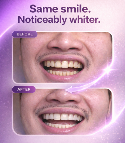 Amorise Purple Whitening Strips